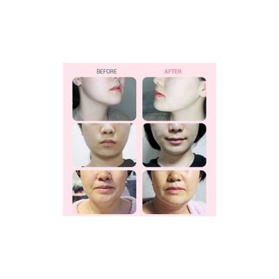 Vline Lifting Pack Hydrogel Moisturizing Care Гидрогелевая лифтинг-маска для зоны подбородка